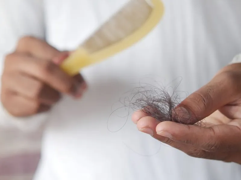 Caída de Pelo